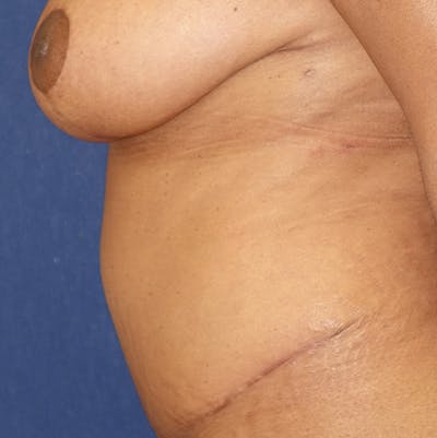 Tummy Tuck (Abdominoplasty) Gallery - Patient 141725961 - Image 6