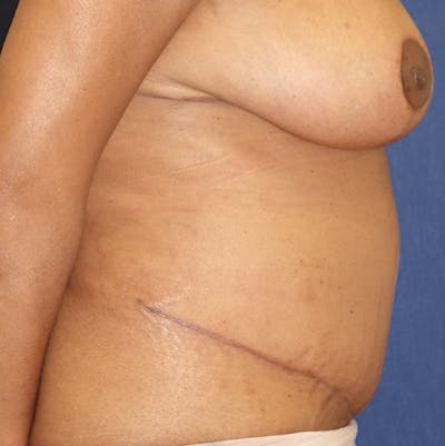 Tummy Tuck (Abdominoplasty) Gallery - Patient 141725961 - Image 10