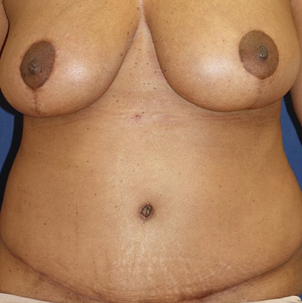 Tummy Tuck (Abdominoplasty) Gallery - Patient 141725961 - Image 2