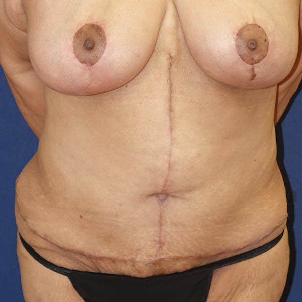 Tummy Tuck (Abdominoplasty) Gallery - Patient 141726022 - Image 2