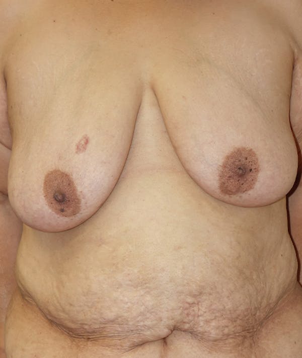 Breast Lift Gallery - Patient 141726143 - Image 1