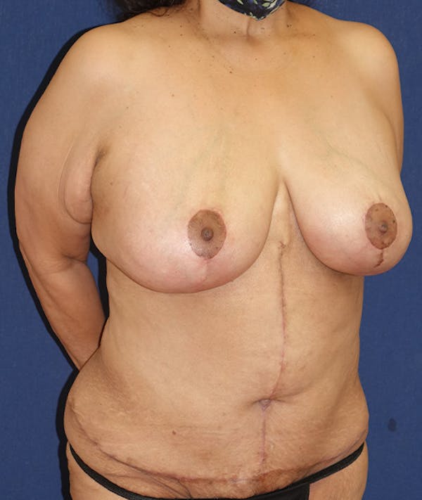 Breast Lift Gallery - Patient 141726143 - Image 6