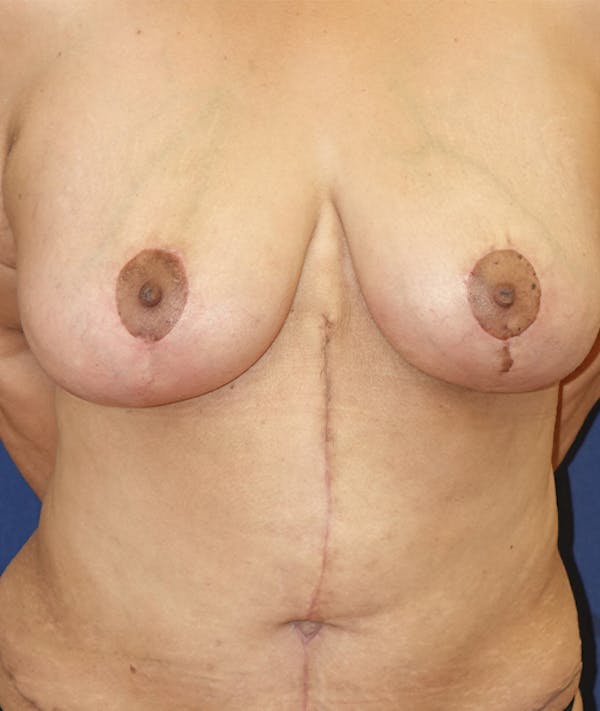 Breast Lift Gallery - Patient 141726143 - Image 2