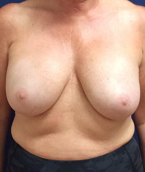 Breast Lift Gallery - Patient 141726221 - Image 1