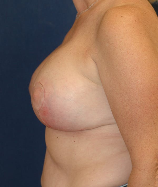 Breast Lift Gallery - Patient 141726221 - Image 10