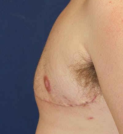 Masculinizing Surgery Gallery - Patient 141726250 - Image 10