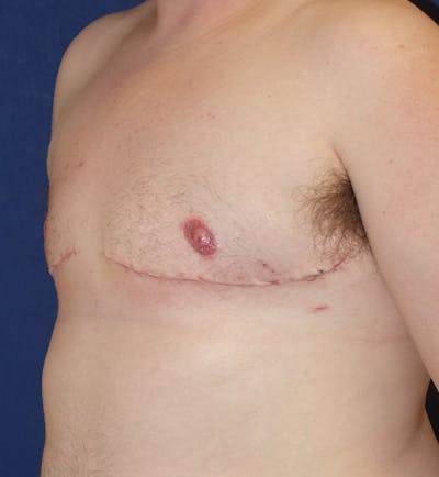 Masculinizing Surgery Gallery - Patient 141726250 - Image 8