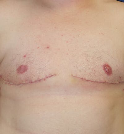 Masculinizing Surgery Gallery - Patient 141726250 - Image 2