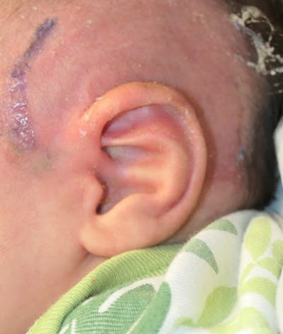Pediatric Ear Molding Gallery - Patient 142705177 - Image 4