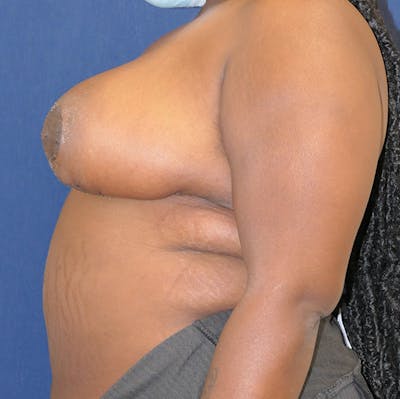 Breast Reduction Gallery - Patient 142705178 - Image 10
