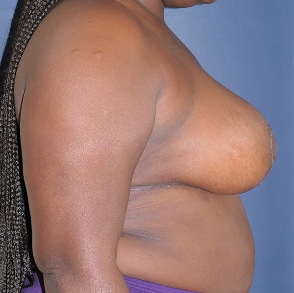 Breast Reduction Gallery - Patient 142705182 - Image 6