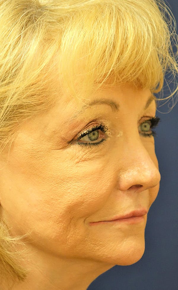 Eyelid Lift (Blepharoplasty) Gallery - Patient 143554477 - Image 3