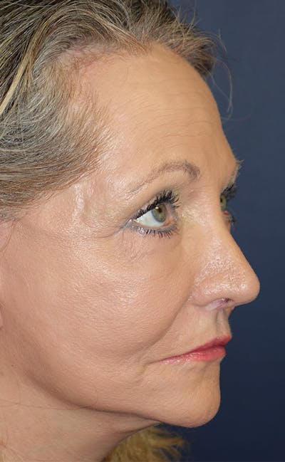 Eyelid Lift (Blepharoplasty) Gallery - Patient 143554477 - Image 4