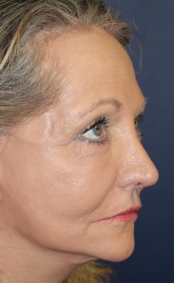 Facelift Gallery - Patient 143554469 - Image 4