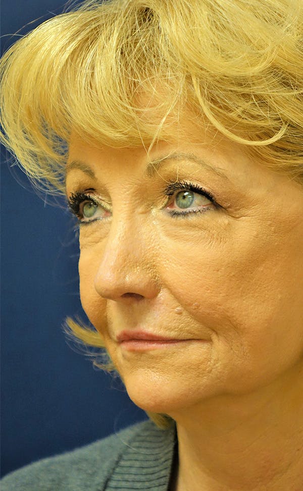 Eyelid Lift (Blepharoplasty) Gallery - Patient 143554477 - Image 7