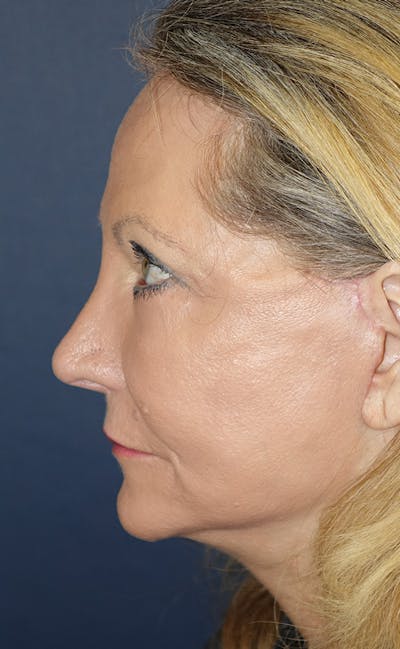 Eyelid Lift (Blepharoplasty) Gallery - Patient 143554477 - Image 10