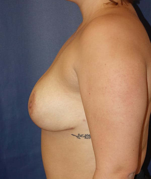 Breast Lift Gallery - Patient 143554503 - Image 10
