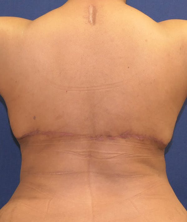 Breast Reconstruction Gallery - Patient 143554506 - Image 12