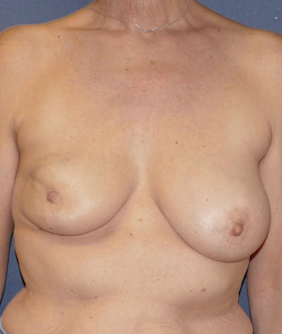 Breast Lift Gallery - Patient 143554511 - Image 1