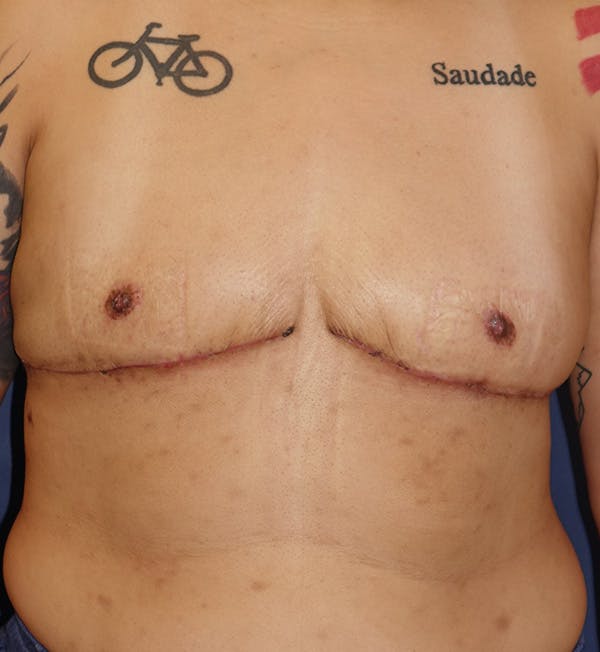 Masculinizing Surgery Gallery - Patient 143554525 - Image 2