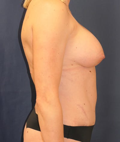 Breast Augmentation Gallery - Patient 118002373 - Image 4