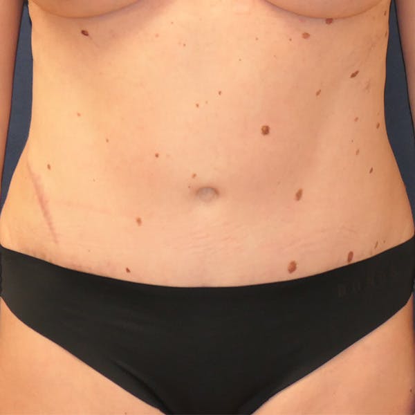 Tummy Tuck (Abdominoplasty) Gallery - Patient 118002486 - Image 2