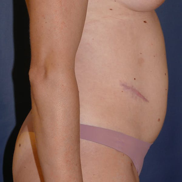 Tummy Tuck (Abdominoplasty) Gallery - Patient 118002486 - Image 3