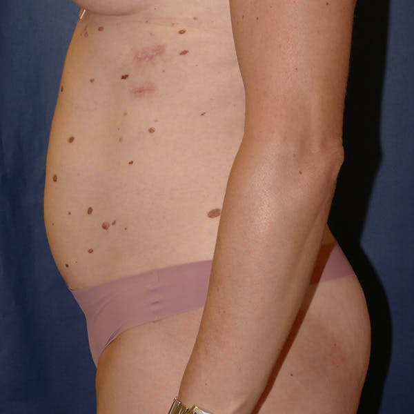 Tummy Tuck (Abdominoplasty) Gallery - Patient 118002486 - Image 5