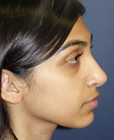 Rhinoplasty Gallery - Patient 4861642 - Image 4