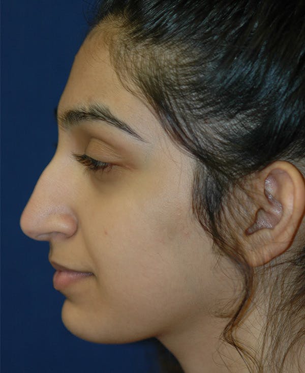 Rhinoplasty Gallery - Patient 4861642 - Image 5