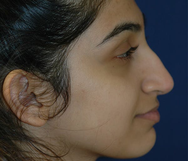 Ear Pinning (Otoplasty) Gallery - Patient 144611820 - Image 3