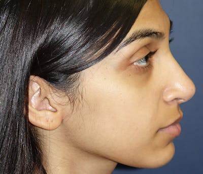 Ear Pinning (Otoplasty) Gallery - Patient 144611820 - Image 4