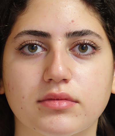 Rhinoplasty Gallery - Patient 144611823 - Image 1