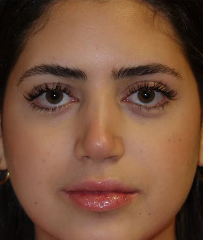 Rhinoplasty Gallery - Patient 144611823 - Image 2