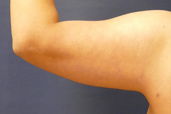 Arm Lift (Brachioplasty) Gallery - Patient 147667893 - Image 5