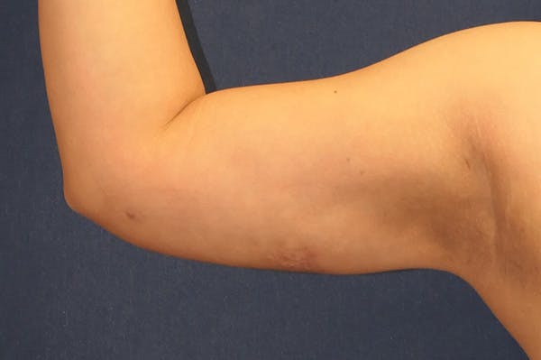 Arm Lift (Brachioplasty) Gallery - Patient 147667893 - Image 8