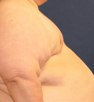 Masculinizing Surgery Gallery - Patient 147694867 - Image 4