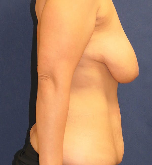 Tummy Tuck (Abdominoplasty) Gallery - Patient 148223744 - Image 5