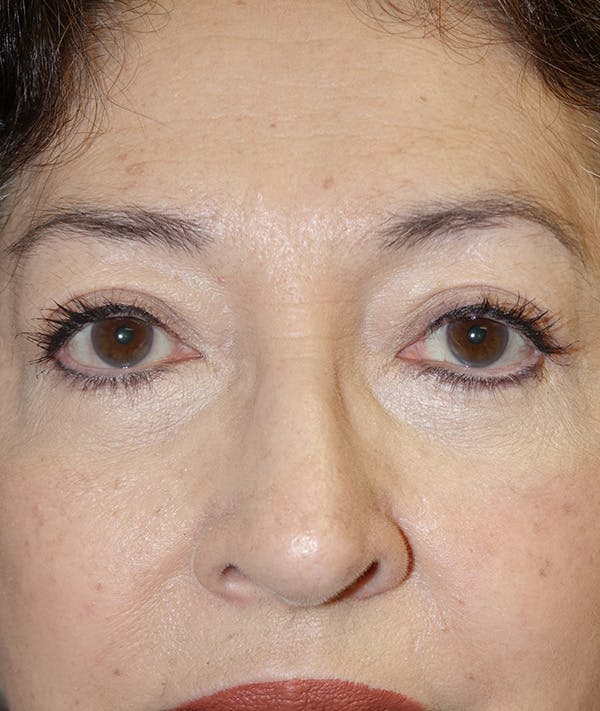 Eyelid Lift (Blepharoplasty) Gallery - Patient 148829202 - Image 2