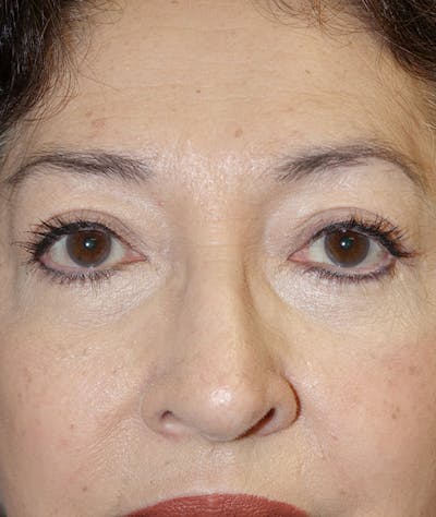 Eyelid Lift (Blepharoplasty) Gallery - Patient 148829202 - Image 2