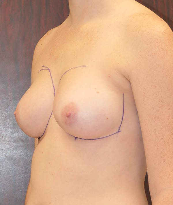 Breast Augmentation Gallery - Patient 148829194 - Image 7