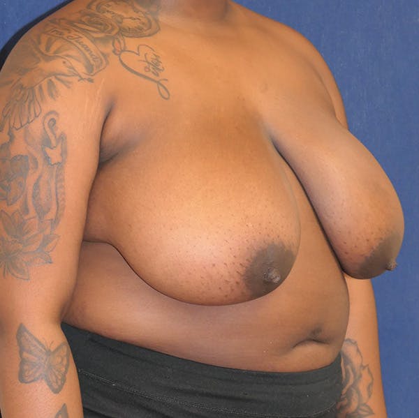 Breast Reduction Gallery - Patient 148829183 - Image 3