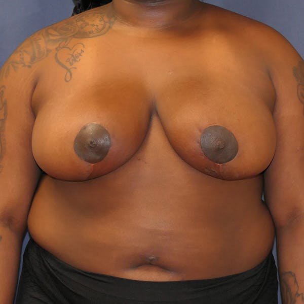 Breast Reduction Gallery - Patient 148829183 - Image 2