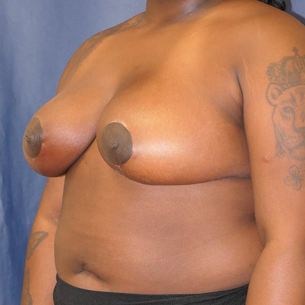 Breast Reduction Gallery - Patient 148829183 - Image 8