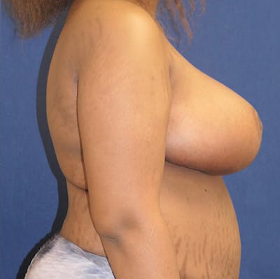 Breast Reduction Gallery - Patient 148829182 - Image 6