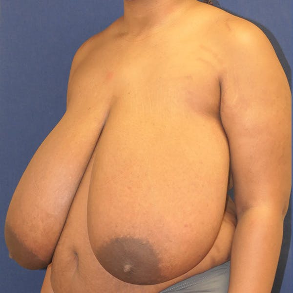 Breast Reduction Gallery - Patient 148829182 - Image 7