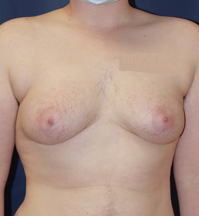 Masculinizing Surgery Gallery - Patient 148829189 - Image 1