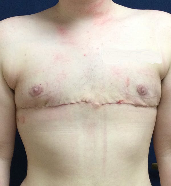 Masculinizing Surgery Gallery - Patient 148829189 - Image 2