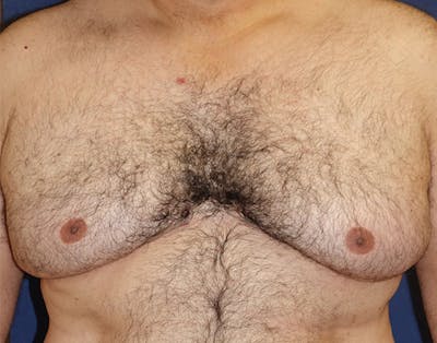 Male Subcutaneous Mastectomy (Gynecomastia) Gallery - Patient 148829205 - Image 1