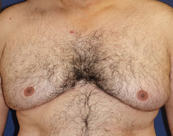 Male Subcutaneous Mastectomy (Gynecomastia) Gallery - Patient 148829205 - Image 1